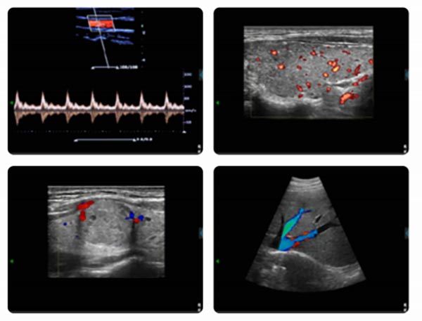 Handheld Ultrasound Machine